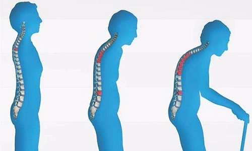 Osteoporoz Sorunlarını Önler Sağlıklı kemikler için faydalı olan tuzun yaklaşık 4 1 i kemiklerde depolanmaktadır